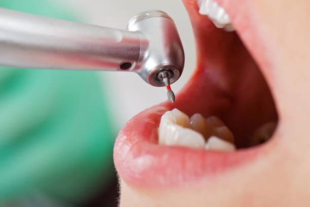 Best Emergency Broken Tooth Repair in Denver, CO